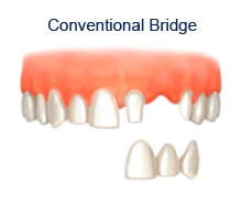 dental bridgework sheffield, dental care Sheffield, lost tooth, smile makeover, improve smile, missing teeth